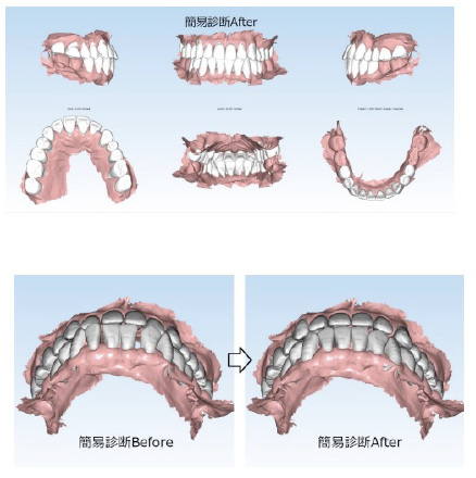 マウスピース（アライナー）による矯正